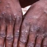 monkeypox