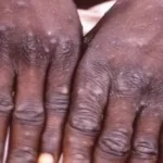 monkeypox