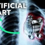 Artificial heart