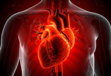 Heart diseases