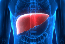 liver cirrhosis